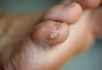 Warze am kleinen Zeh