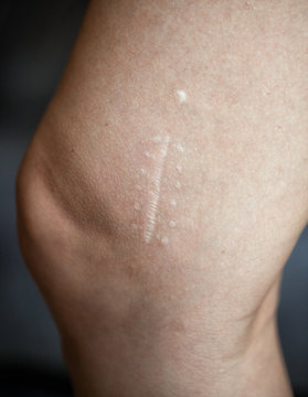 Narbe am Knie