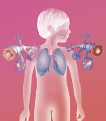 Depiction of a healthy bronchial tube (left) and a bronchial tube during an asthma attack (right)