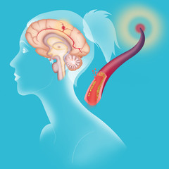 Depiction of an ischemic stroke, or cerebrovascular accident (CVA)