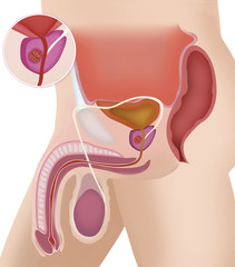 Cancer of the prostate, drawing