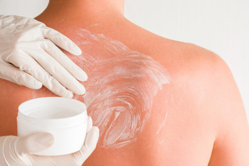 On young man's back skin hands in white rubber gloves smears cream after sun burn.
