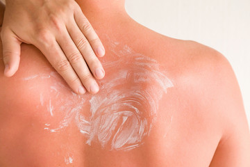 Young man smears cream on his back skin after sun burn.