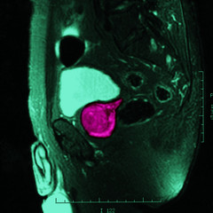Prostatic adenoma, mri