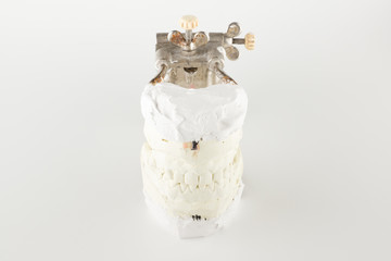 Occludator with plastered dentition models