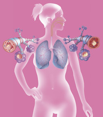 Depiction of a healthy bronchial tube (left) and a bronchial tube during an asthma attack (right)
