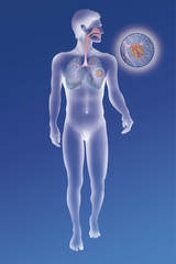Depiction of a cancerous tumour in the left lung