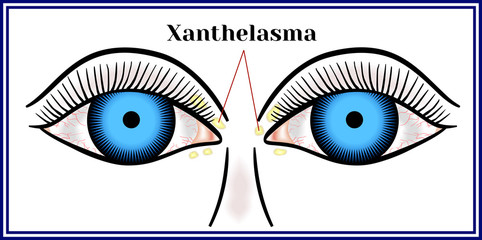 Xanthelasma. Flattened benign neoplasm.