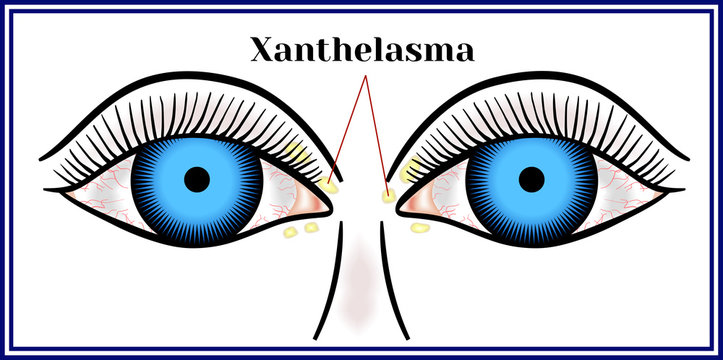 Xanthelasma. Flattened benign neoplasm.