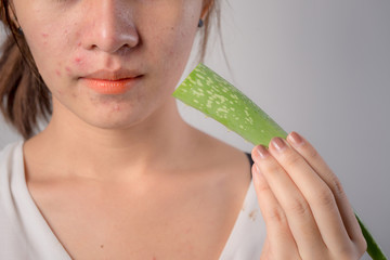 Asian woman with aloe vera on her. imperfection skin
