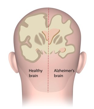 Healthy brain vs. Alzheimer's 