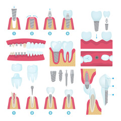Set of dental crowns and implantation prosthodontics elements and tools. Vector flat illustration.