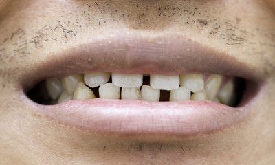 Obraz premium Yellow teeth