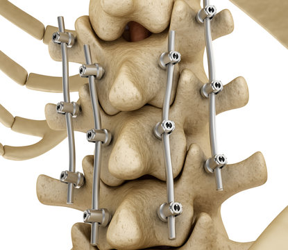 Spinal fixation system - titanium bracket. Medically accurate tooth 3D illustration