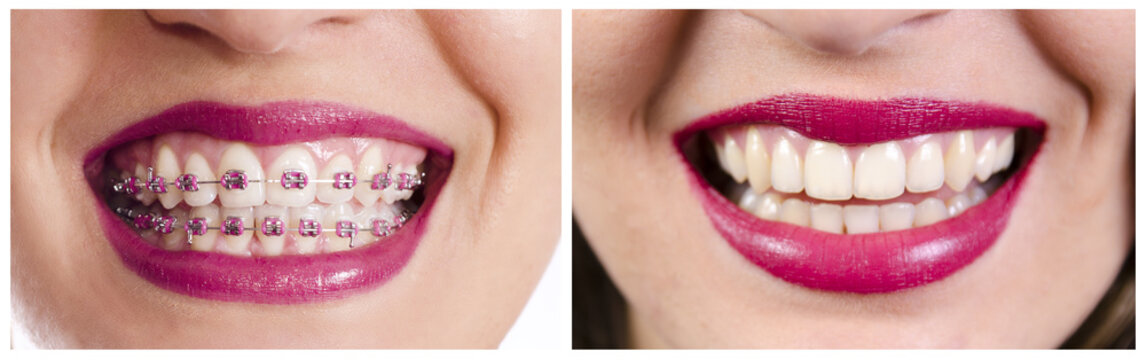 Dental collage, closeup of teeth before and after dental braces, same woman 2 year difference, authentic image 