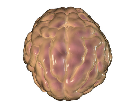 Meningitis, 3D illustration showing swelling of meninges and presence of purulent exudate under meninges