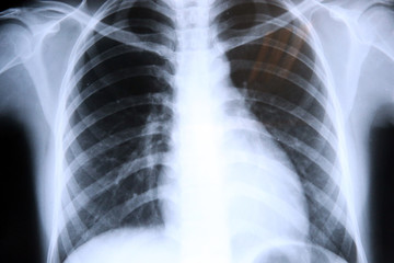 Lungs radiography. x-rays.