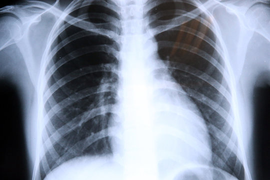 Lungs radiography. x-rays.