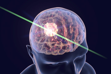 Destruction of brain tumor by laser, 3D illustration. Conceptual image for brain cancer treatment - obrazy, fototapety, plakaty
