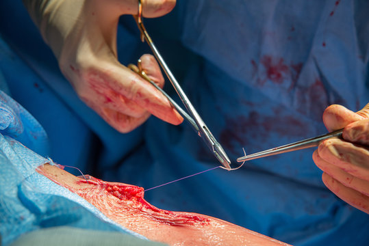 HIP PROSTHESIS, SURGERY