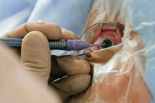 CATARACT, SURGERY