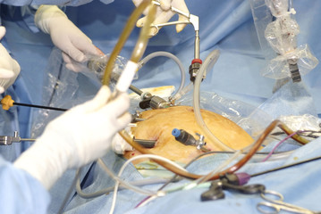 RECTAL RESECTION LAPAROSCOPY