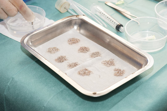 HAIR TRANSPLANTATION