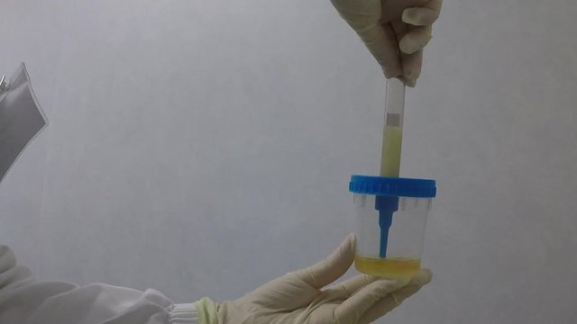 urine sample from a patient's sample in a private clinic