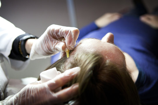 CARBOXYTHERAPY
