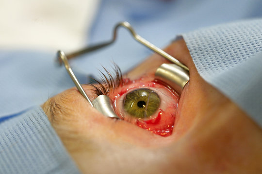 STRABISMUS, SURGERY