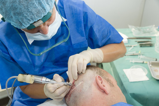 HAIR TRANSPLANTATION