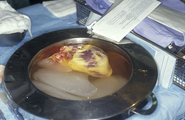 HEART TRANSPLANT
