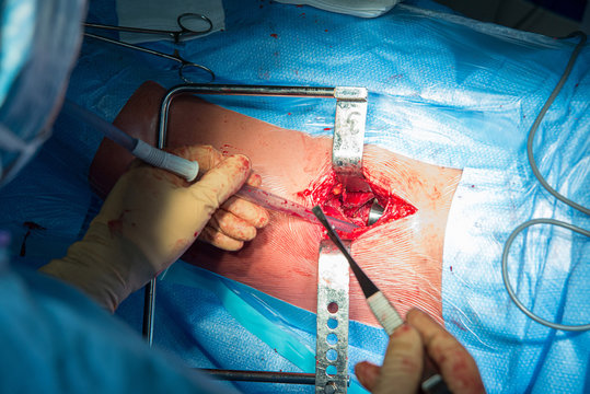 HIP PROSTHESIS, SURGERY