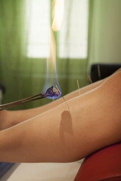 ACUPUNCTURE