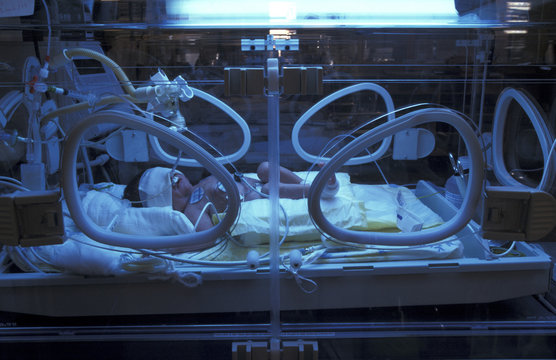NEONATAL JAUNDICE, PHOTOTHERAPY