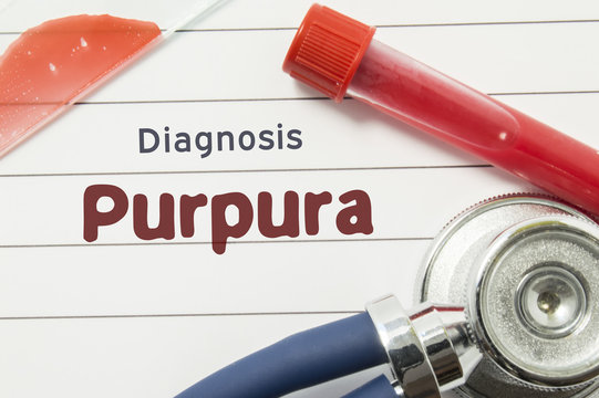 Diagnosis of Purpura. Medical book with text header hematological diagnosis Purpura lies on doctor table surrounded by laboratory test tubes with blood, glass slide with blood smear and stethoscope