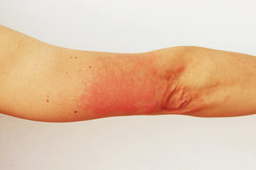 Red pustules and vesicles on the skin of the hand as symptoms of photodermatitis. Allergic reaction...