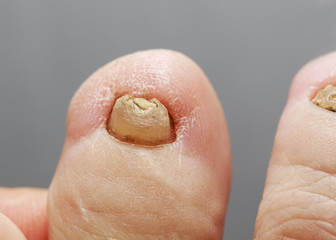 unpleasant toes with toenails affected by fungal disease