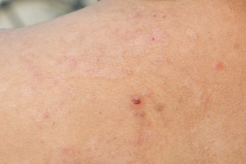 Psoriasis on the skin
