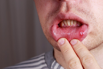 Stomatitis on the lips
