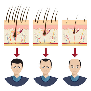 Hair loss illustration.