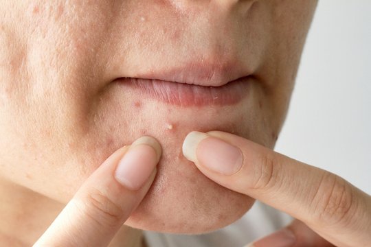 Acne pus, Close up photo of acne prone skin, Woman squeezing her pimple, Removing pimple from her face.