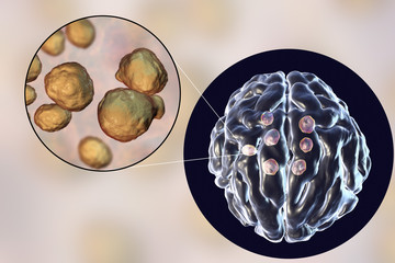 Multiple cryptococcal cysts in brain, cryptococcoma, and close-up view of pathogenic fungi Cryptococcus. 3D illustration