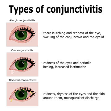 Types of conjunctivitis