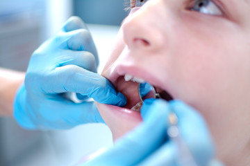 Close up of little girl with open mouth having dental check up in dental clinic.