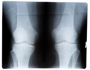 Knee joint x-ray, front view