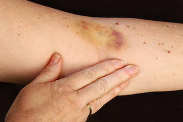 Ein Hämatom am Arm einer Frau. Ein großer blauer Fleck am Arm