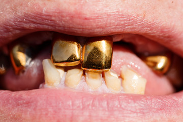 Golden teeth. Mouth without teeth. Old woman without teeth. Macro photography. Mouth. Tooth. 