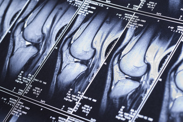 My knee MRI - damage of cross-shaped ligaments