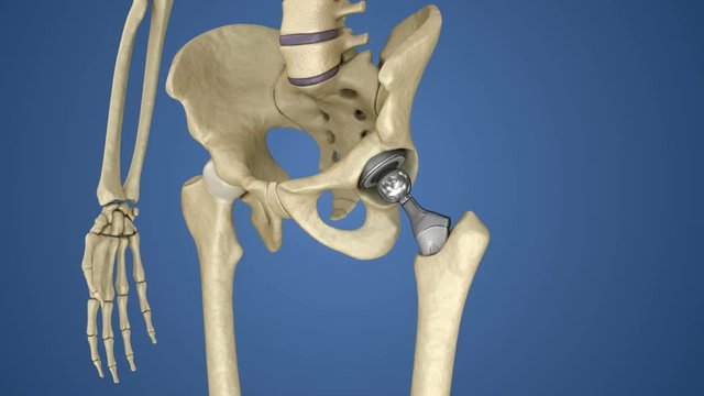 Hip replacement implant installed in the pelvis bone. Medically accurate  3D animation